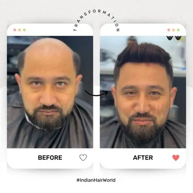 Before Hair Transplant